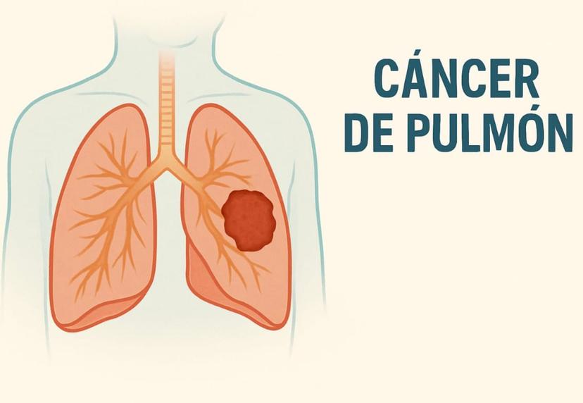 Cáncer de pulmón - Imagen hero